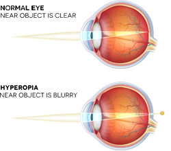 Farsighted Diagram